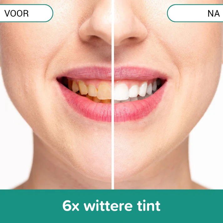 SmileFresh️ | Plaque- und Fleckenentferner