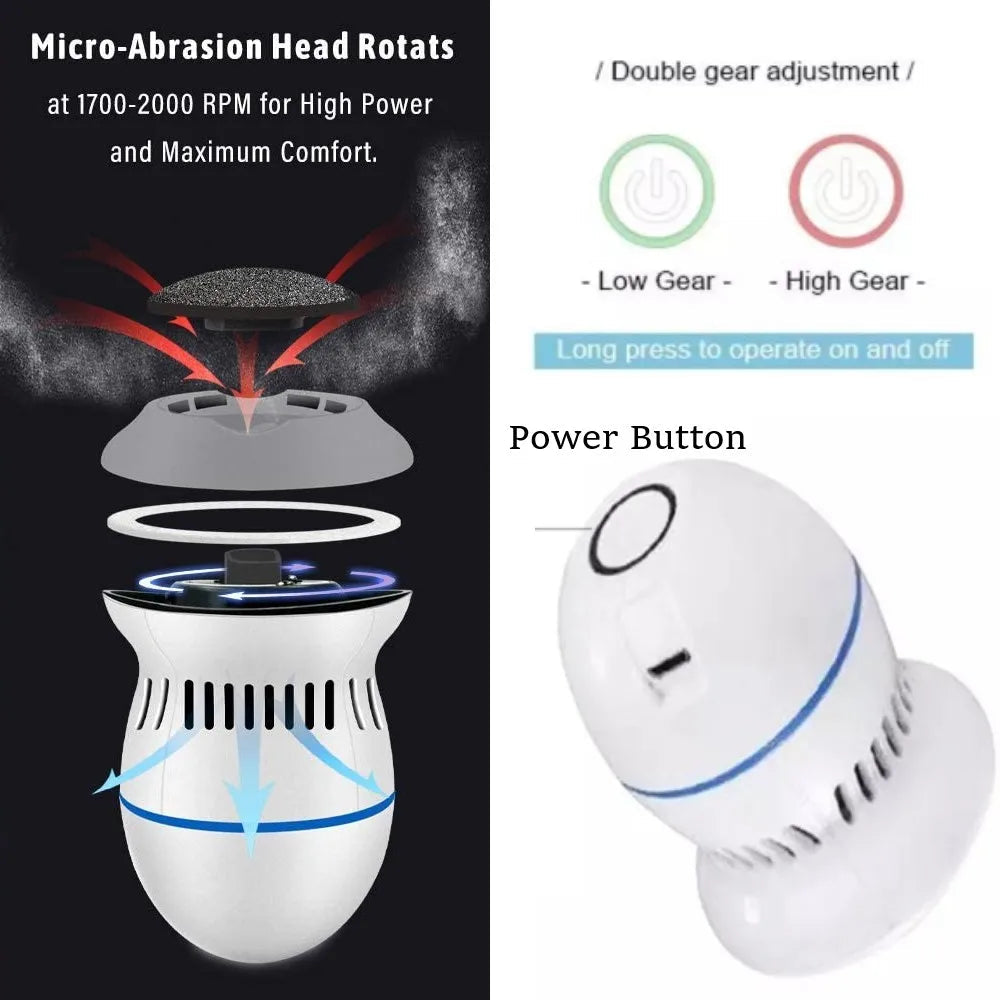 Vakuum-Hornhautentferner