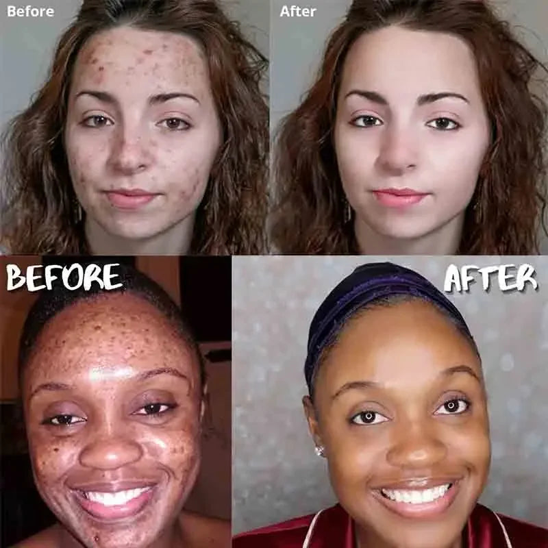 Sandsberg | Kurkuma Seife Gesichtsreinigung Anti Akne Entfernen Pickel Dunkle Flecken