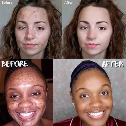 Sandsberg | Kurkuma Seife Gesichtsreinigung Anti Akne Entfernen Pickel Dunkle Flecken